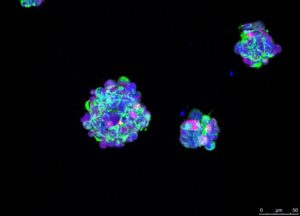 Imaxe microscópica dun cultivo de células derivadas dun glioblastoma dun paciente.